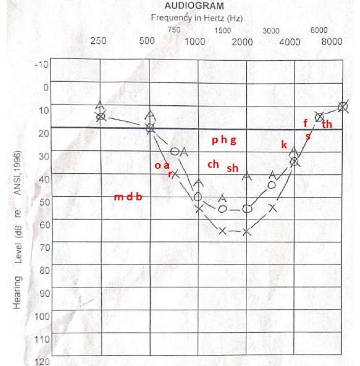 An audiogram of an individual with hearing loss in the mid-frequencies.